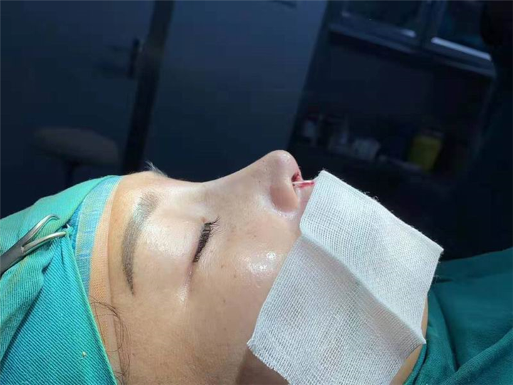 新疆鼻整形修复专家