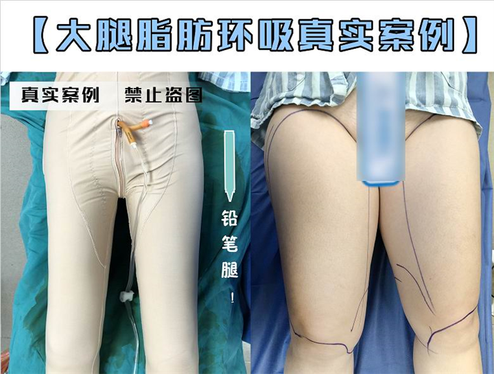 新疆吸脂整形专家