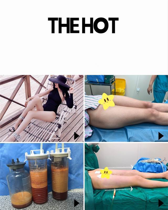 新疆吸脂整形专家