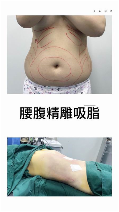 新疆吸脂整形专家