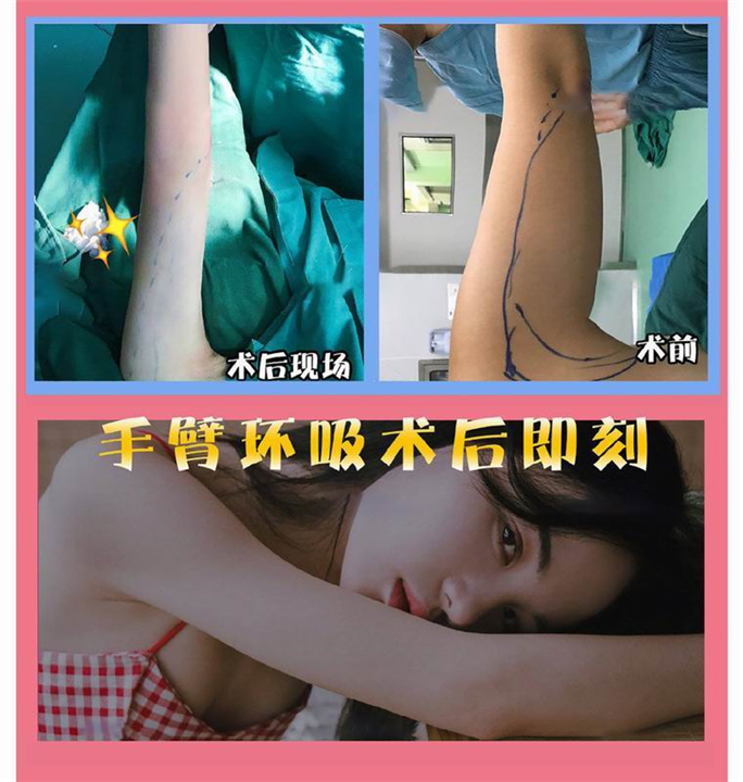 新疆吸脂整形专家