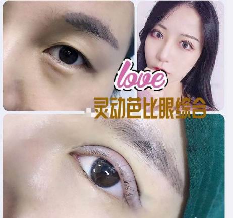 新疆眼部整形专家