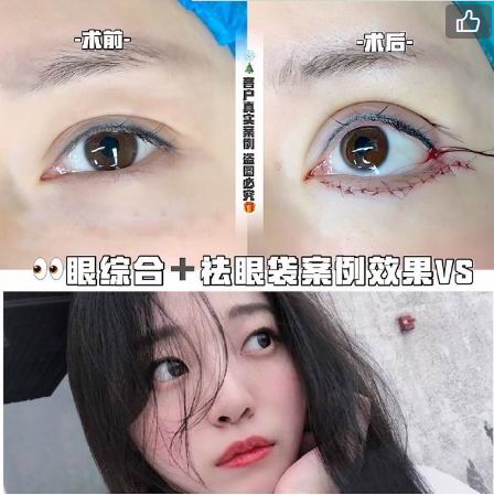 新疆眼部整形专家