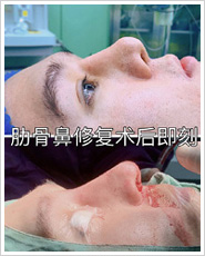新疆鼻整形修复专家
