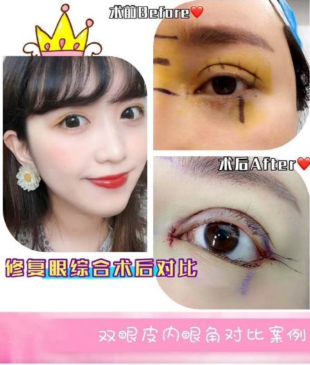 新疆眼部整形修复专家