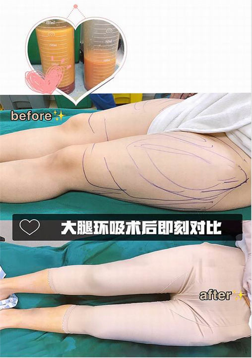 新疆吸脂整形专家